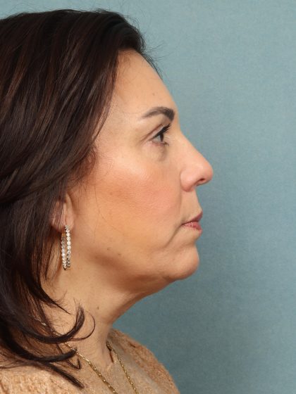 Blepharoplasty Before & After Patient #10032