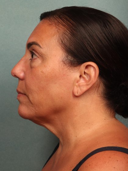 Blepharoplasty Before & After Patient #10032