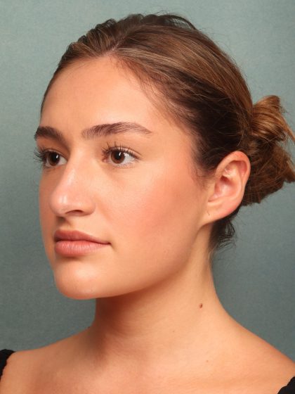 Rhinoplasty Before & After Patient #10045