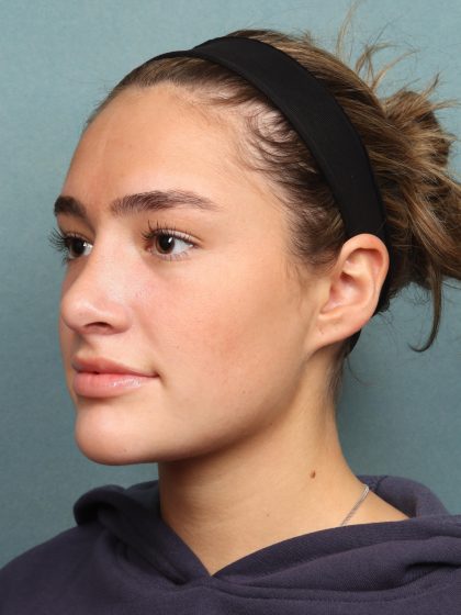Rhinoplasty Before & After Patient #10045