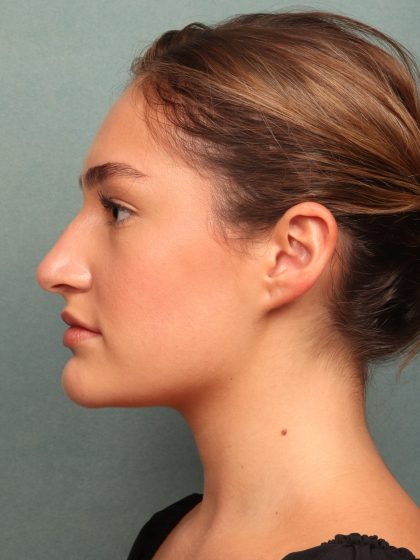 Rhinoplasty Before & After Patient #10045