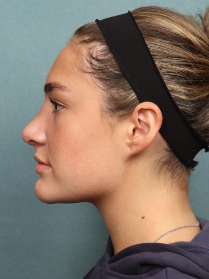 Rhinoplasty Before & After Patient #10045