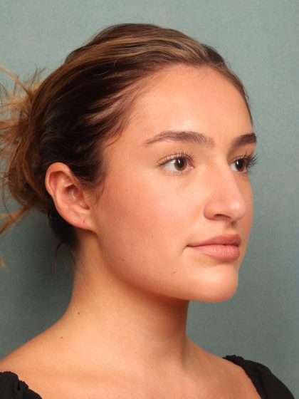 Rhinoplasty Before & After Patient #10045
