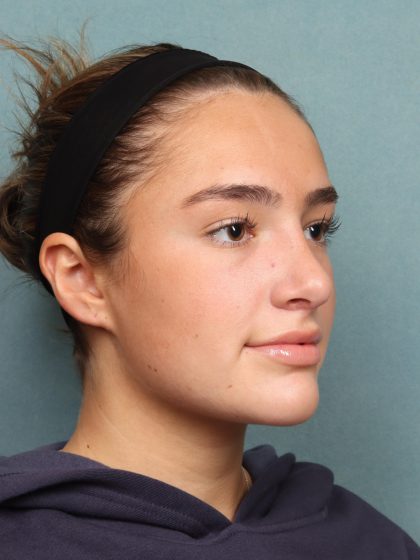 Rhinoplasty Before & After Patient #10045