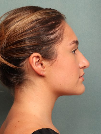 Rhinoplasty Before & After Patient #10045