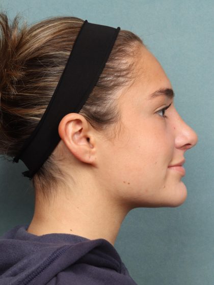 Rhinoplasty Before & After Patient #10045