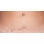 Scar & Stretch Mark Treatment Before & After Patient #10098