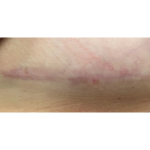 Scar & Stretch Mark Treatment Before & After Patient #10099
