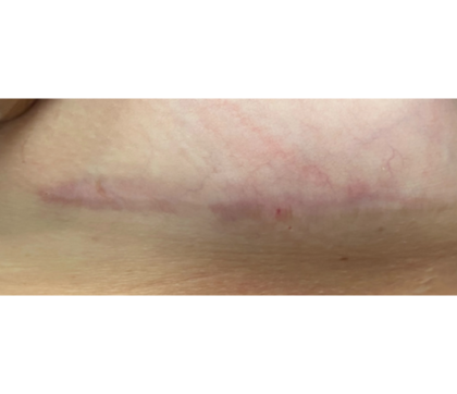 Scar & Stretch Mark Treatment Before & After Patient #10099