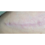 Scar & Stretch Mark Treatment Before & After Patient #10099