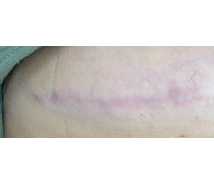 Scar & Stretch Mark Treatment Before & After Patient #10099