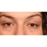 Blepharoplasty Before & After Patient #10041