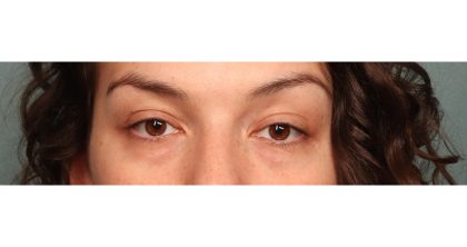 Blepharoplasty Before & After Patient #10041