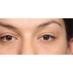 Blepharoplasty Before & After Patient #10041
