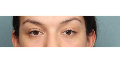 Blepharoplasty Before & After Patient #10041