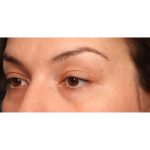 Blepharoplasty Before & After Patient #10041