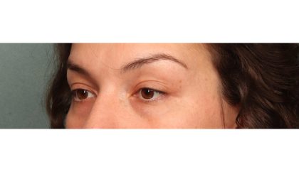 Blepharoplasty Before & After Patient #10041