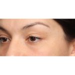 Blepharoplasty Before & After Patient #10041