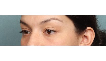 Blepharoplasty Before & After Patient #10041