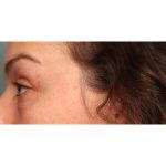 Blepharoplasty Before & After Patient #10041