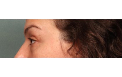 Blepharoplasty Before & After Patient #10041