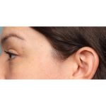 Blepharoplasty Before & After Patient #10041