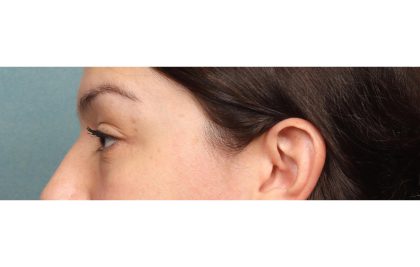 Blepharoplasty Before & After Patient #10041
