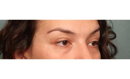 Blepharoplasty Before & After Patient #10041