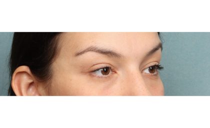 Blepharoplasty Before & After Patient #10041