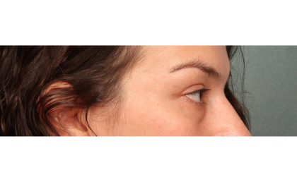 Blepharoplasty Before & After Patient #10041