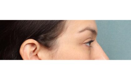 Blepharoplasty Before & After Patient #10041