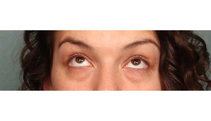 Blepharoplasty Before & After Patient #10041