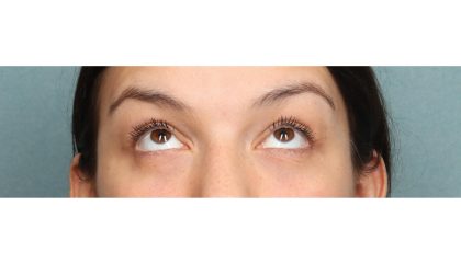 Blepharoplasty Before & After Patient #10041