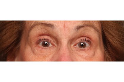 Lower Blepharoplasty Before & After Patient #10044