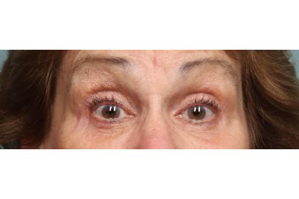 Lower Blepharoplasty Before & After Patient #10044