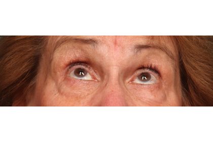Lower Blepharoplasty Before & After Patient #10044