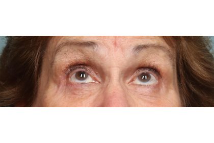 Lower Blepharoplasty Before & After Patient #10044
