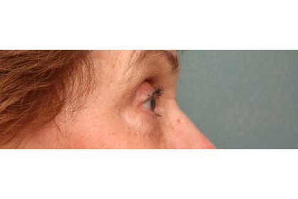 Lower Blepharoplasty Before & After Patient #10044