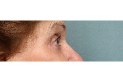 Lower Blepharoplasty Before & After Patient #10044