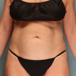 Tummy Tuck Before & After Patient #10122