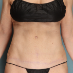 Tummy Tuck Before & After Patient #10122