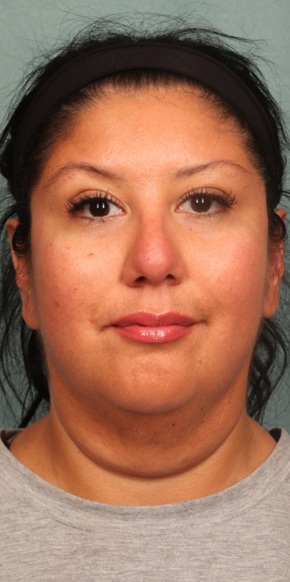 Neck Lift Before & After Patient #10188