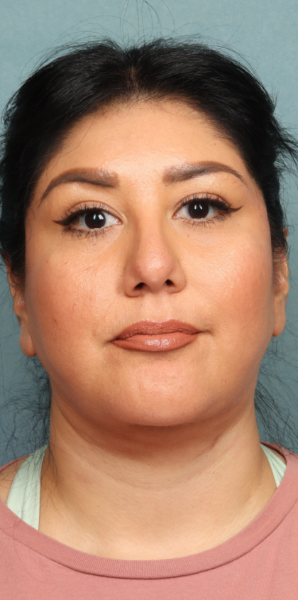 Neck Lift Before & After Patient #10188