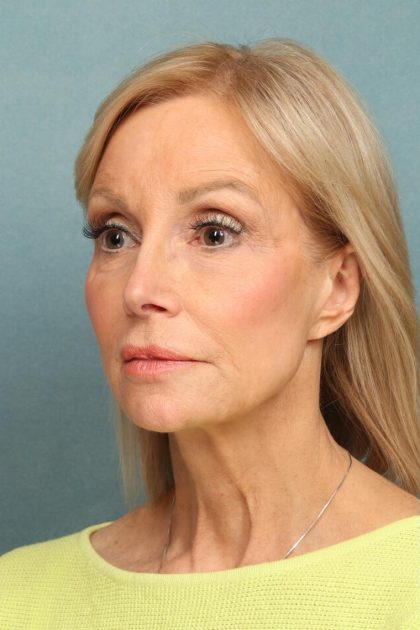 Neck Lift Before & After Patient #10197
