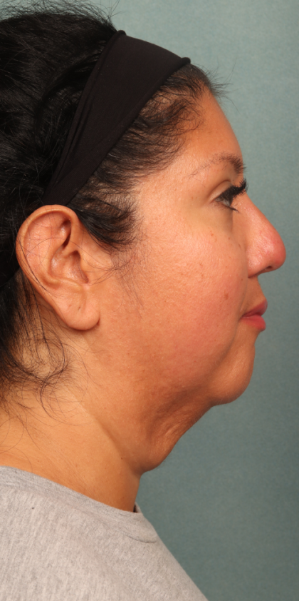 Neck Lift Before & After Patient #10188