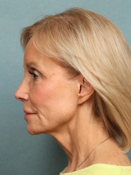 Neck Lift Before & After Patient #10197