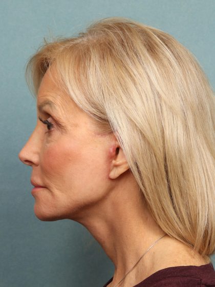 Neck Lift Before & After Patient #10197