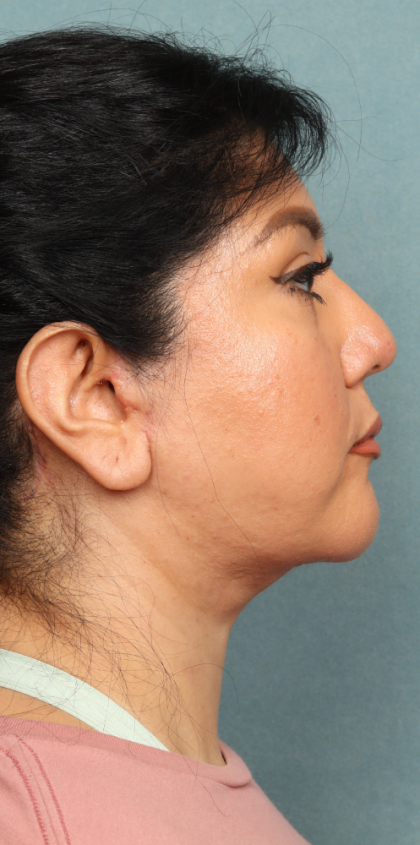 Neck Lift Before & After Patient #10188