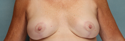 Breast Implant Removal Before & After Patient #10350