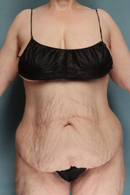 Tummy Tuck Before & After Patient #10403